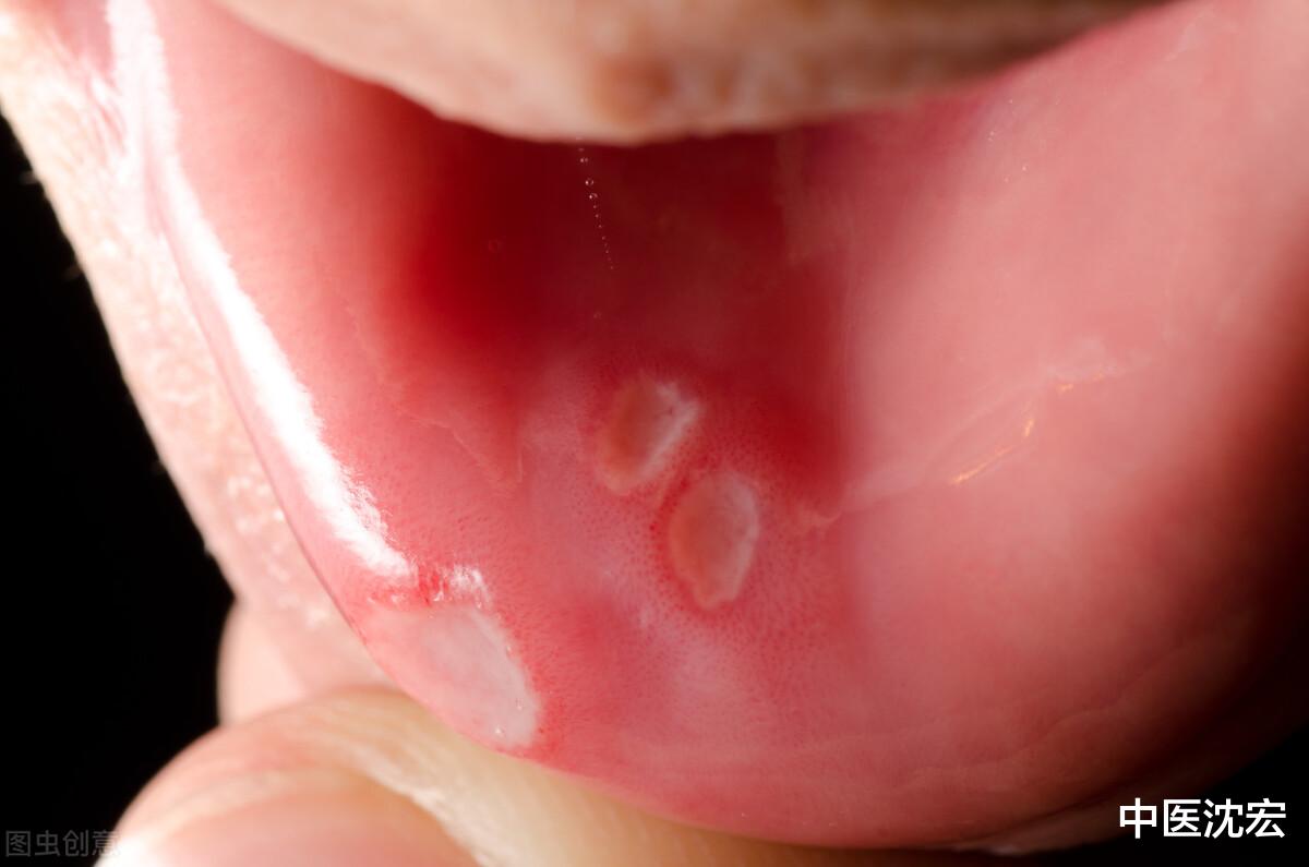 带状疱疹|口腔溃疡,清热解毒没有?教你辨证,对症治疗才有效