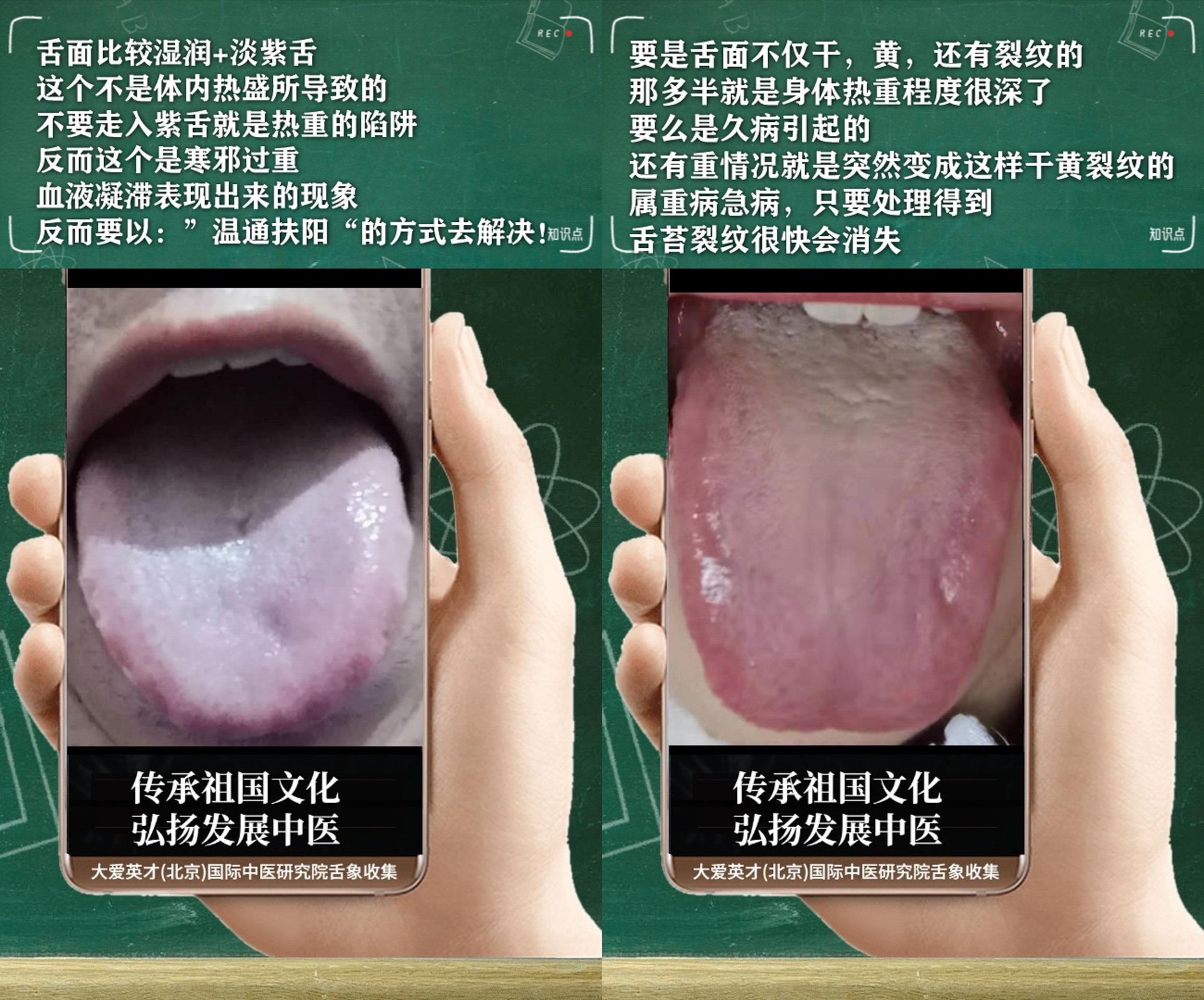 失眠|中医医案：反复胃痛，胸闷，心烦失眠，排便无力，记忆力下降