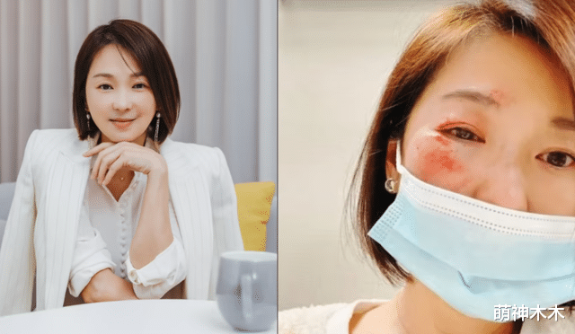 姐弟恋|46岁女星自曝脸部受伤,姐弟恋结婚11年,被担心遭家暴收百条信息