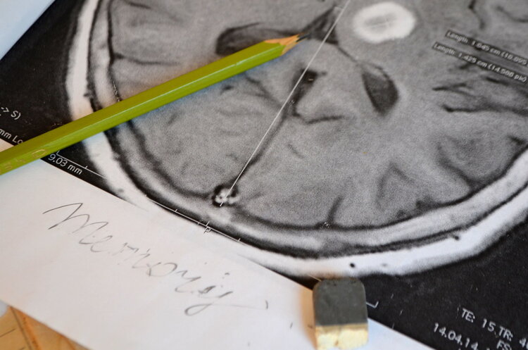 脑梗|颈动脉斑块最终归宿是脑梗吗?提醒:坚持做好3点,斑块或会逆转