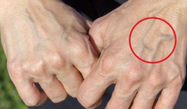 运动|有的人手臂“青筋暴起”,而有的人几乎看不到青筋,哪种更健康