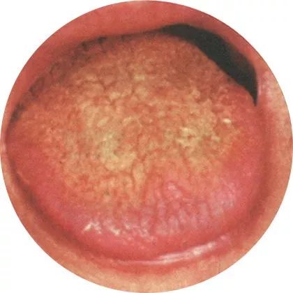 失眠|中医中的舌诊,了解吗