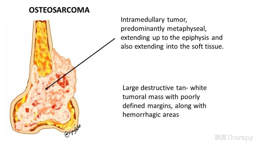 |孩子腿疼,需要重视吗?医生:警惕骨肉瘤,专找孩子下手