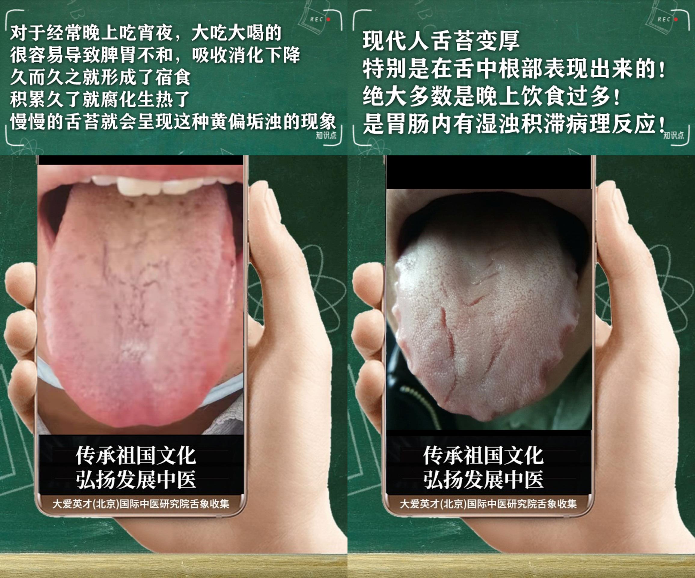 心律失常|反反复复胃胀气,心悸气短,便秘,脾胃不和的舌象案例讲解