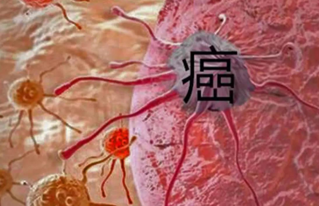 心肌梗塞|肿瘤医生放弃治疗，中医“古方”每天喝，8年了没有复发