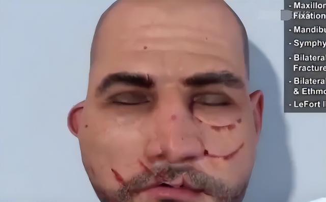 林志颖|这就是脸部3D重建?网友:看着都肉疼,林志颖得遭受多大的苦啊!