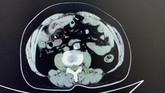 红枣|一颗红枣下肚 老人痛失部分小肠