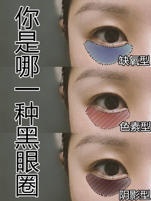 眼妆 你是哪种黑眼圈？黑眼圈类型解析，简单几步淡化你的黑眼圈 。