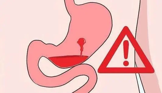 直肠癌|肝硬化患者如何预防上消化道大出血?