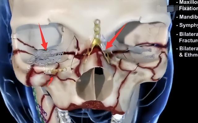 林志颖|这就是脸部3D重建?网友:看着都肉疼,林志颖得遭受多大的苦啊!