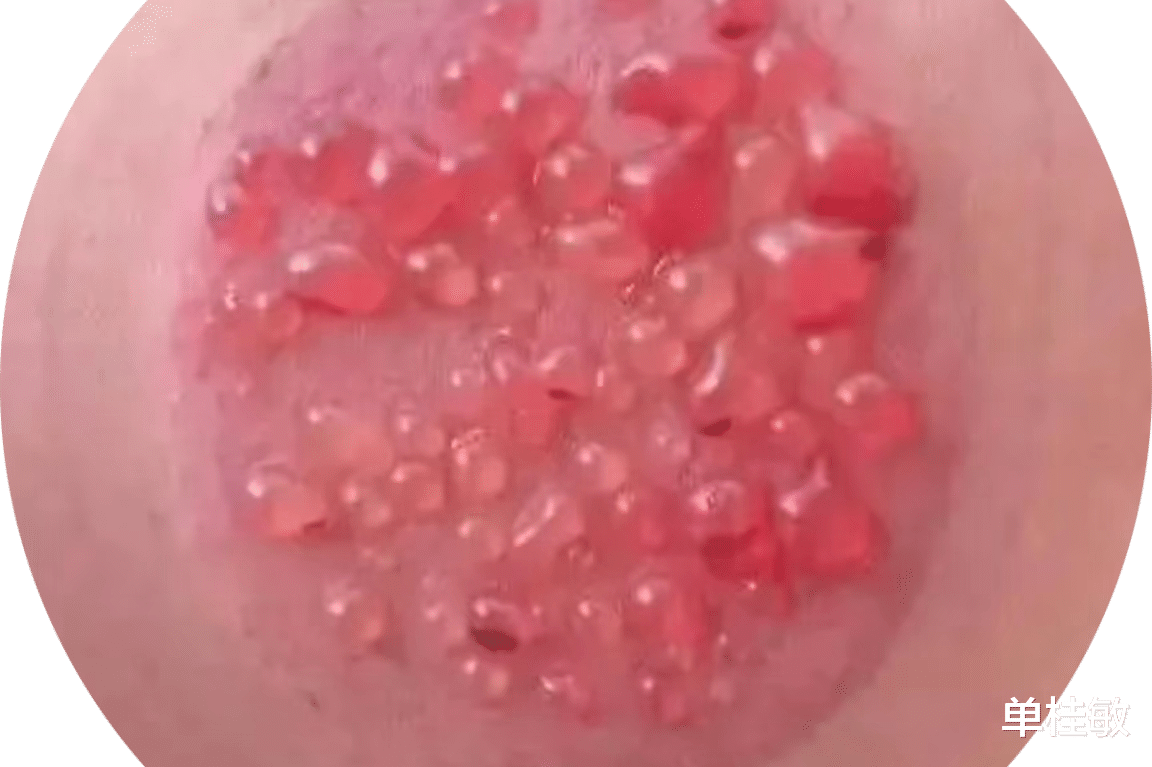 疾病|拔火罐出水泡究竟好不好?