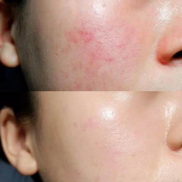 短裙 脸部发红、发烫怎么办？敏感肌专属解决方案来喽