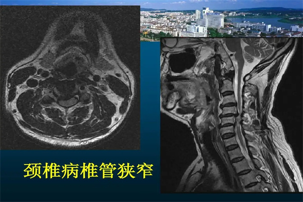 医生|颈椎管狭窄是什么?会带来什么危害?