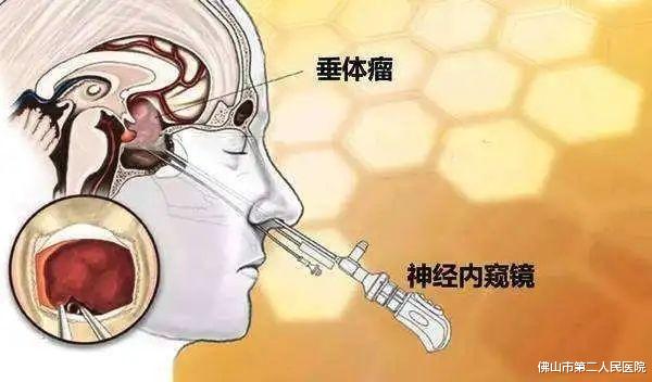 肿瘤|鼻大唇厚，手指粗大？小心！有可能是脑垂体瘤在作祟！
