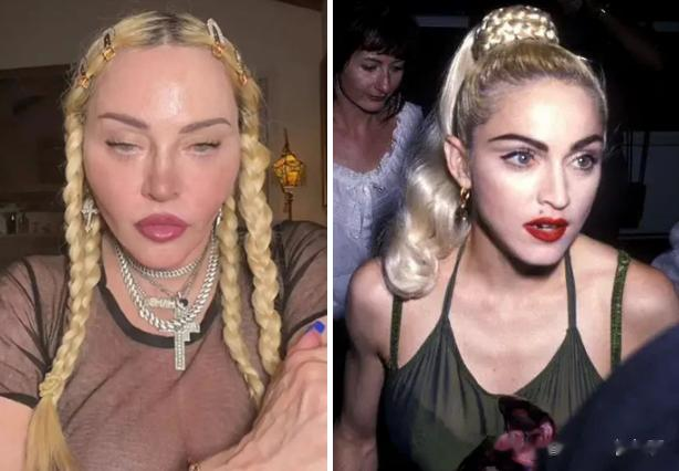 麦当娜|64岁麦当娜承认整容:术后消肿了,看我多可爱