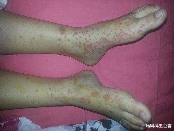 茄子|类风湿拖着不治疗？别等危害找上门才后悔！