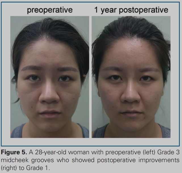熊师:印第安纹的解剖学特点与治疗进展丨专业视点