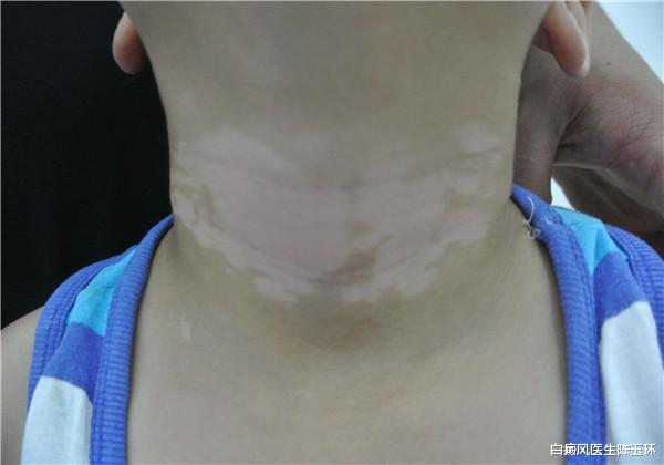 枸杞|日常生活中我们如何预防白癜风