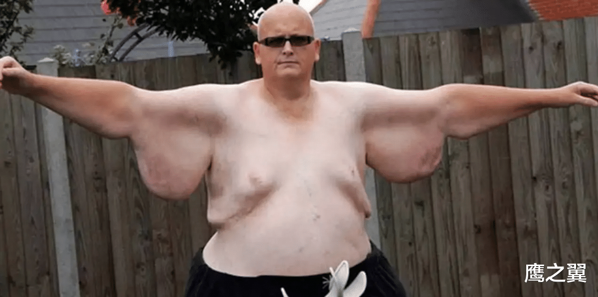 医院 他重达1000多斤,要铲车才能抬上救护车,医院:死了只能送屠宰场