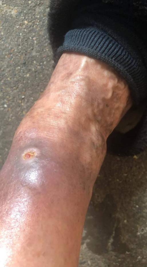 颈椎病|万万没想到,不知不觉中蚯蚓腿也能变烂腿?