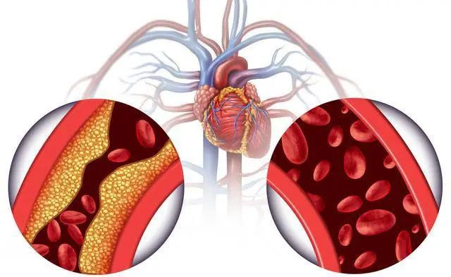 牙齿|心脑血管病越来越多,哪些因素对血管不利?保护血管的方法请收下
