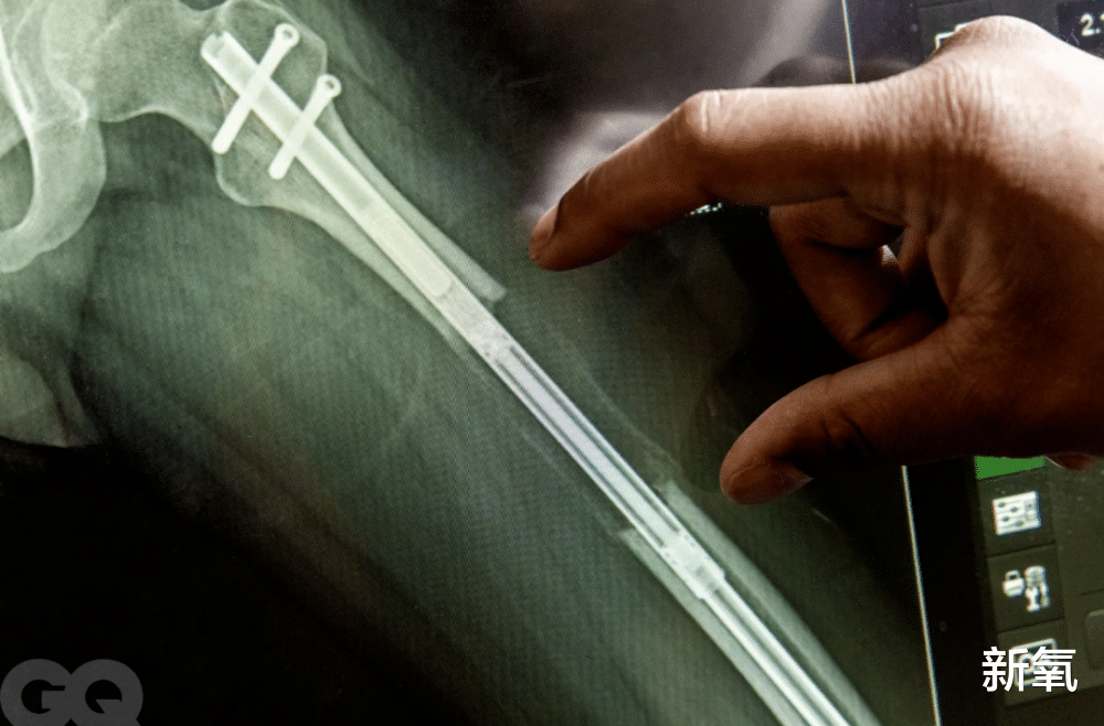 硅谷|邪术or神之手：硅谷男精英的“断骨贷”，到底有多可怕？