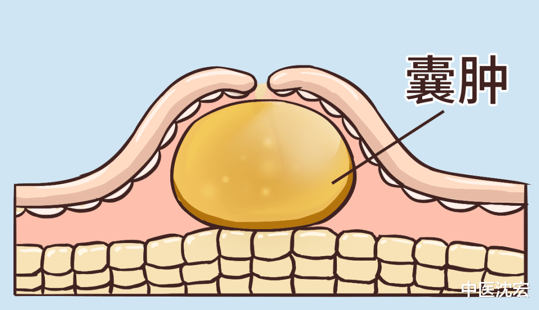医生|痰瘀互结百病生，教你一方，燥湿化痰 活血化瘀，体内痰瘀一网打尽