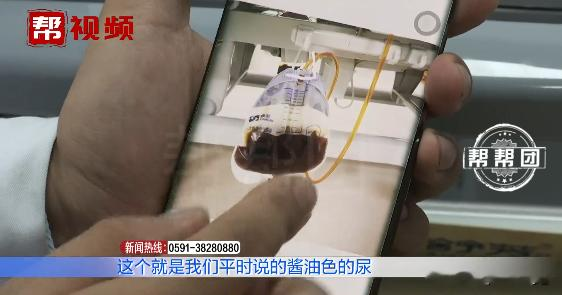 心肌梗塞|高烧不退、全身发黄还尿出酱油色？男子因罕见微生物命悬一线