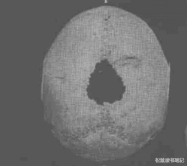 4000年前就有的“开颅”技术,后来为什么失传了?