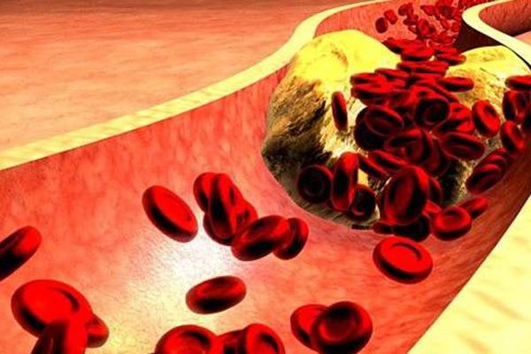胆固醇|胆固醇太高，身体会给出4个提示，早些改善，防止血栓来“拜访”