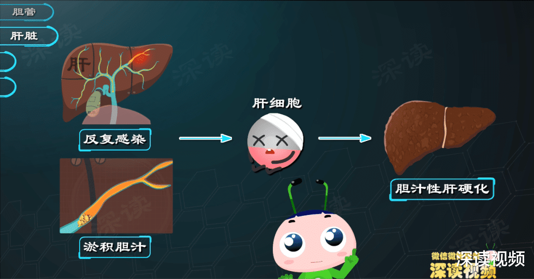 胆管结石|胆管结石是怎么搞坏你的肝，胆，肠，胰的？画得太棒了！