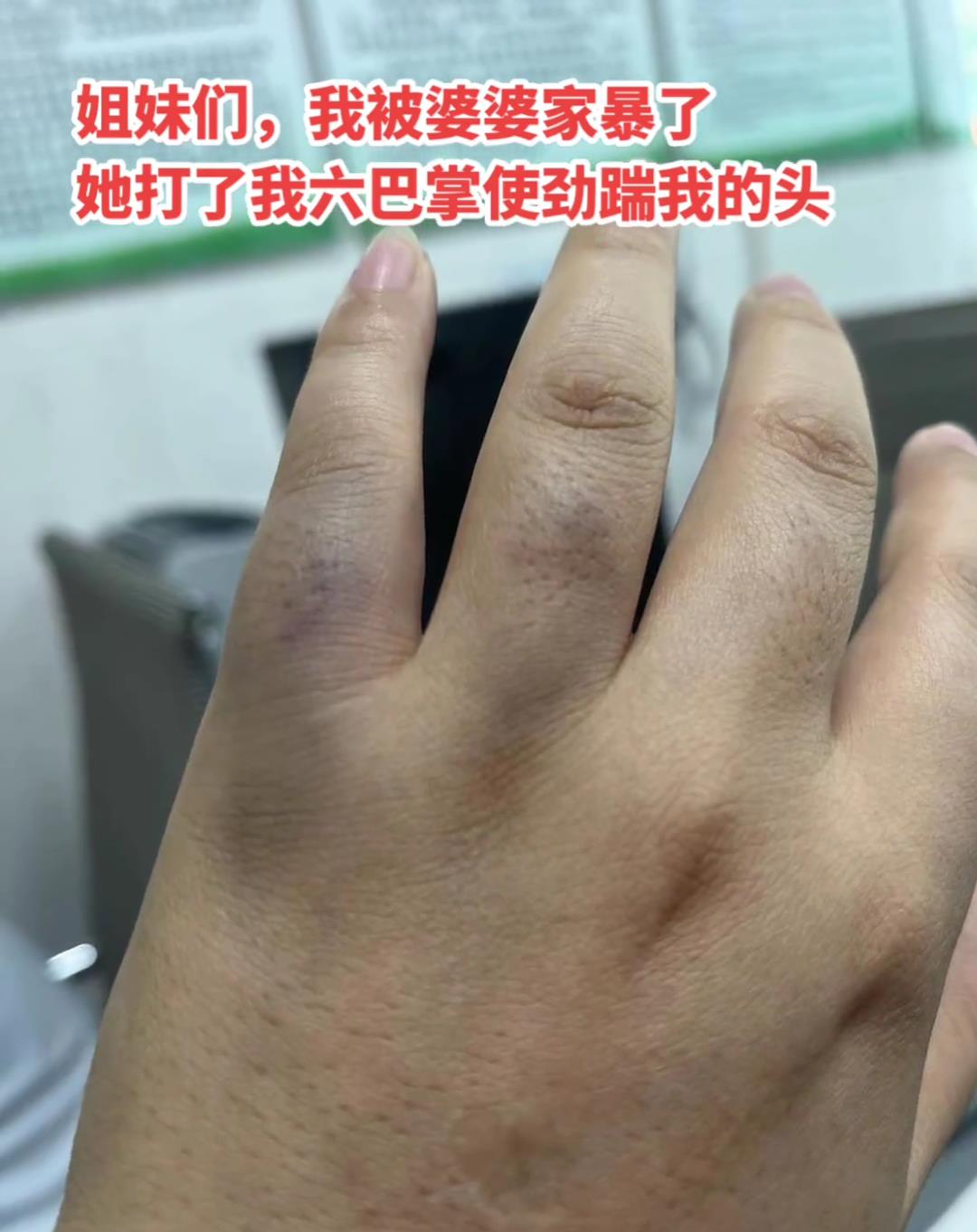 广西:儿媳妇遭恶婆婆暴打,儿媳:她戴镯子捶我还踢我头