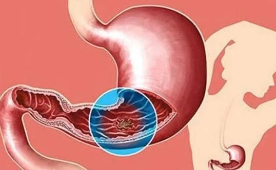 高血压|食物“奥美拉唑”被发现,医生建议敞开吃,或有利于胃部的健康