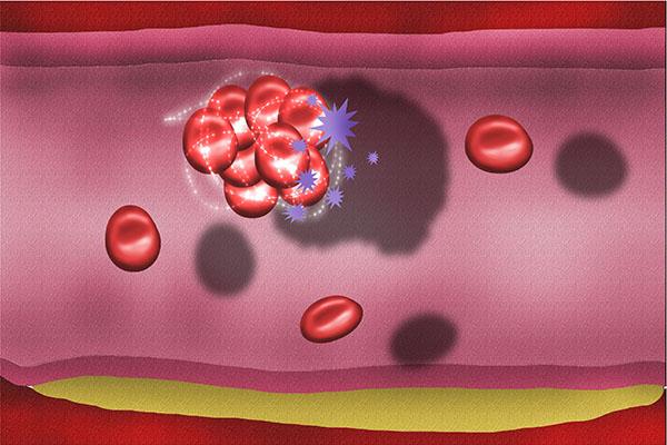 血栓|血液过于粘稠的人,往往身体会出现6个现象,须小心对待