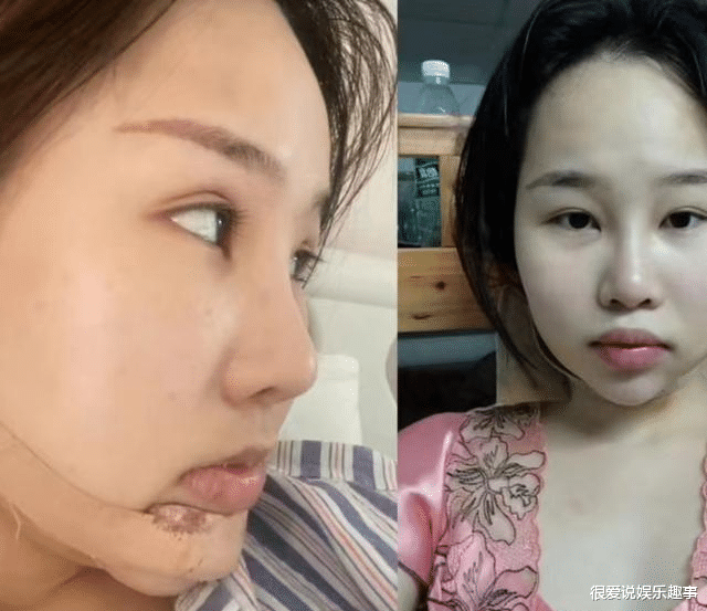 女孩整容被识破,亲戚要求退还100万彩礼:整容堪比换脸影响基因