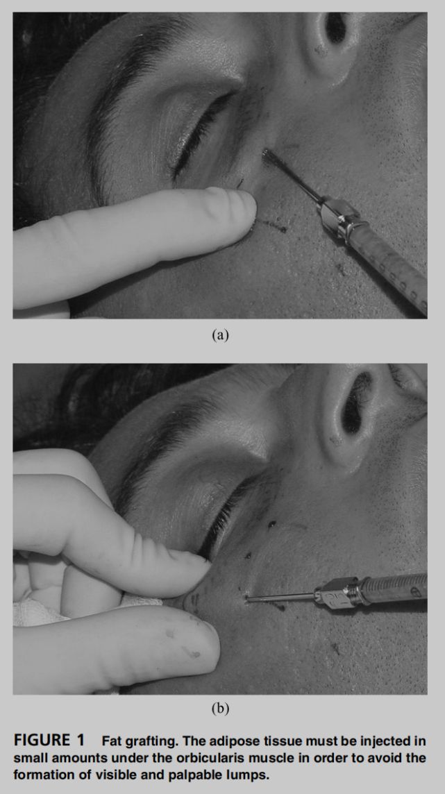 熊师:印第安纹的解剖学特点与治疗进展丨专业视点