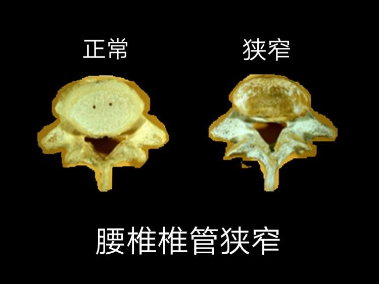 仁济医院|一分钟了解各类引起椎管狭窄的病因