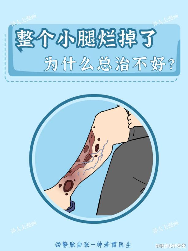 疾病|静脉曲张双腿溃疡，千万别乱治！