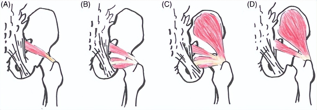 肝脏|臀部酸麻胀痛？你的梨状肌可能损伤了！这几个动作帮你摆脱苦恼！