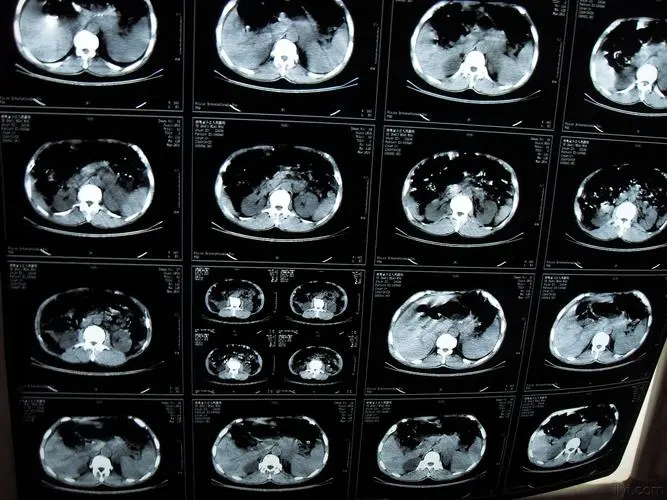 咽炎|胃癌病人为什么要补充维生素?主要是补充哪种?