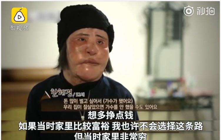 王一博|女星韩慧景:为了更漂亮,给脸注射食用油,把脸整成“猪头”