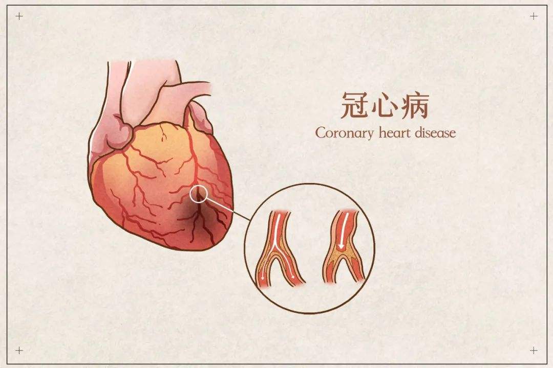 冠心病|冠心病诱发原因有哪些？记住避免这4种危险因素，可有效预防！