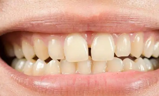 医院|牙缝增大,有可能是牙周炎所致,学习四法,帮助你解决问题,远离牙齿松动