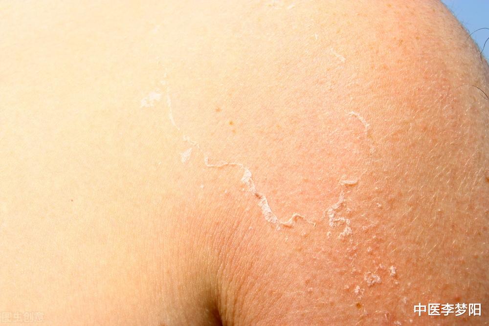 枸杞|血脉不通，脸上疯狂长斑，一个通脉祛瘀方，气血通了，斑也不见了