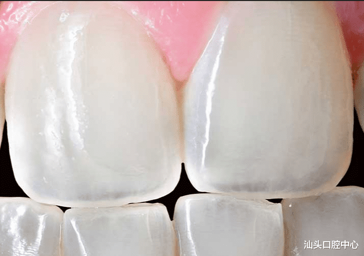 牙齿|牙釉质到底能不能再生?