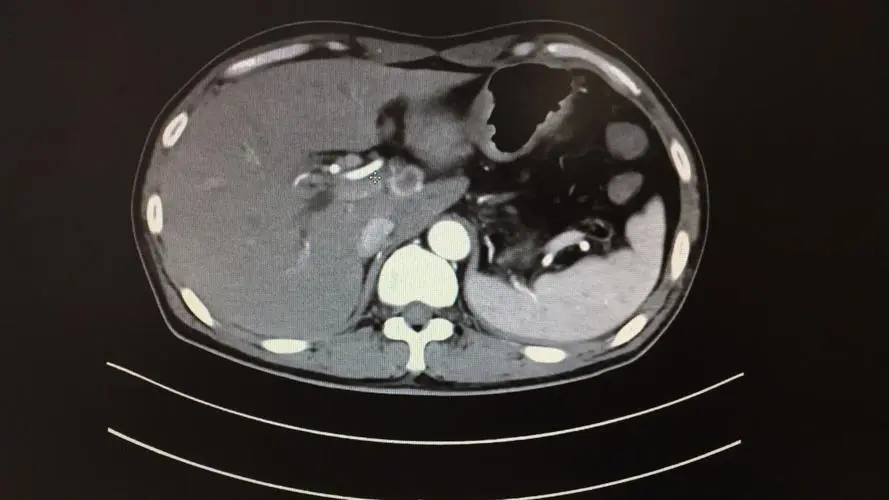 腰肌劳损|“肝占位”一定是肝癌吗?别自己吓自己!先了解清楚再说!