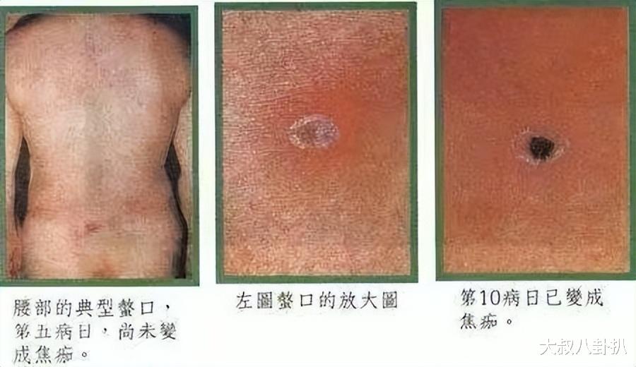 40岁男子高烧三天,医生下达“病危”通知,老专家脱他裤子的操作救了命