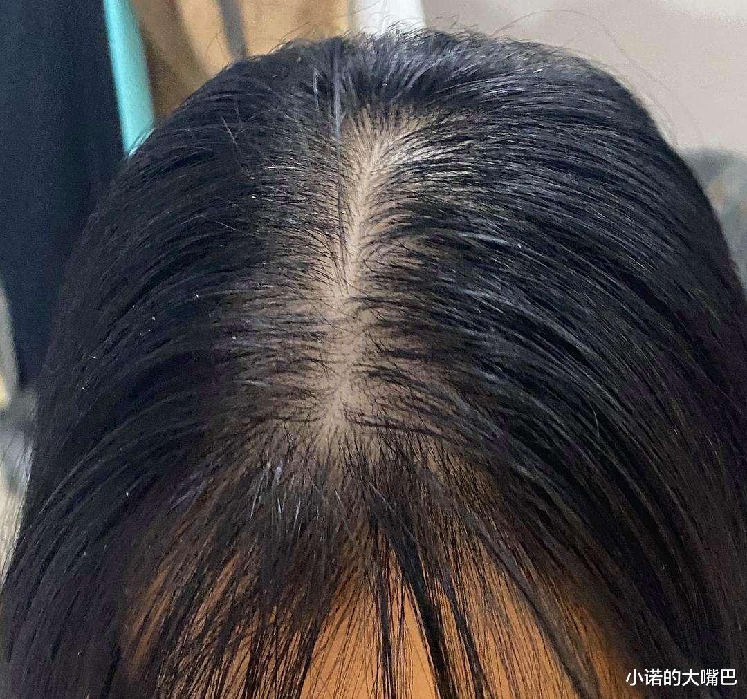 中老年人|【脱发】超市里的6种坚果，每天吃，头发乌黑又茂密