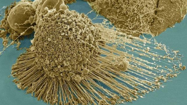 给癌细胞供养70年会怎样？已故黑人女性的癌细胞已分裂达5000万吨