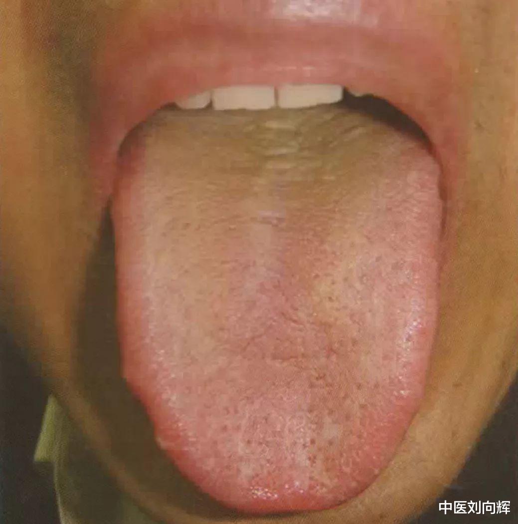 咽炎|咽干、咽痛、咽部异物感,慢性咽炎怎么治?四个小方法统统调理好